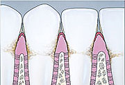 Cross Section Gingivitis