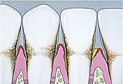 Cross Section Periodontitis