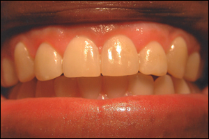 Dental crown after