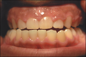 Dental crown before
