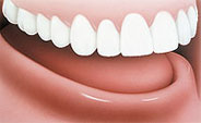 Dentures Implants - Before