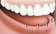 Dentures Implants