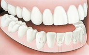 Dentures Implants - After