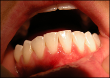 Graft mouth picture - image #2
