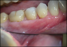 Graft mouth picture - image #4
