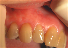Graft mouth picture - image #6
