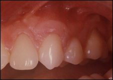Graft mouth picture - image #8