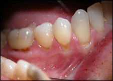 Graft mouth picture - image #3