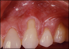 Graft mouth picture - image #7