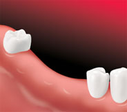 Implant Bridge - Missing teeth
