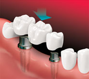 Implant Bridge - A bridge is placed on implants