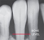 Radiograph diseased