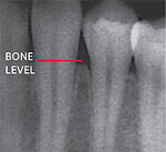 Radiograph normal