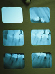 X-Rays | Mountain View Perio