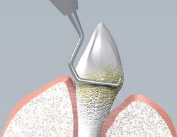 Root planing