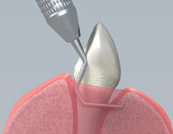 Subgingival