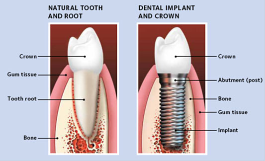 Single Tooth Implant