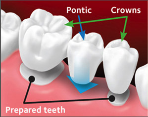 The custom-made bridge is placed over the prepared teeth.