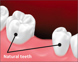 Before the bridge, teeth are shown with the space where a tooth has been lost